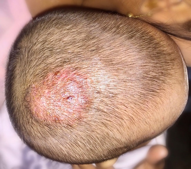 Tinea Kapitis Patofisiologi Diagnosis Penatalaksanaan Alomedika